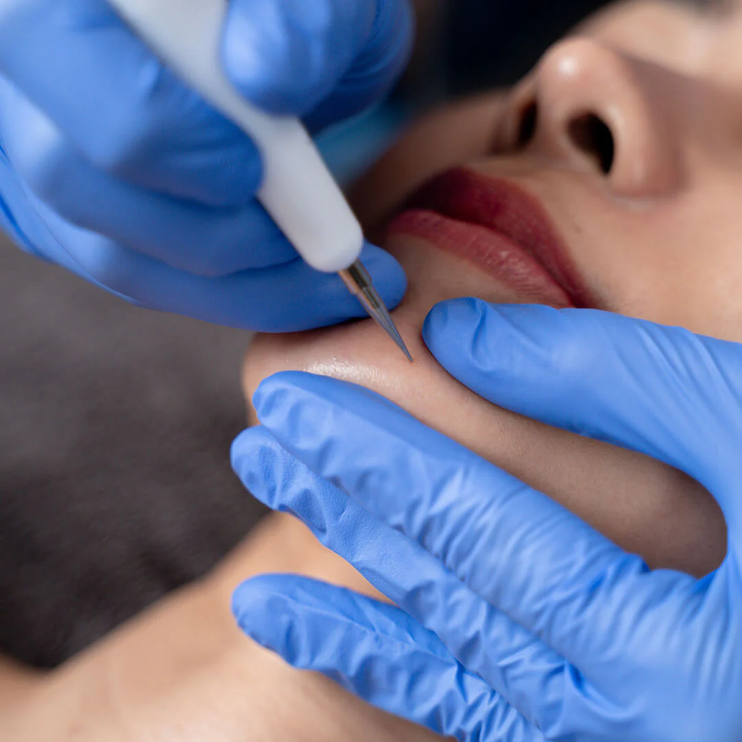 Cautery